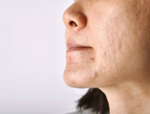 Hoe kun je het beste omgaan met acne of andere huidproblemen?